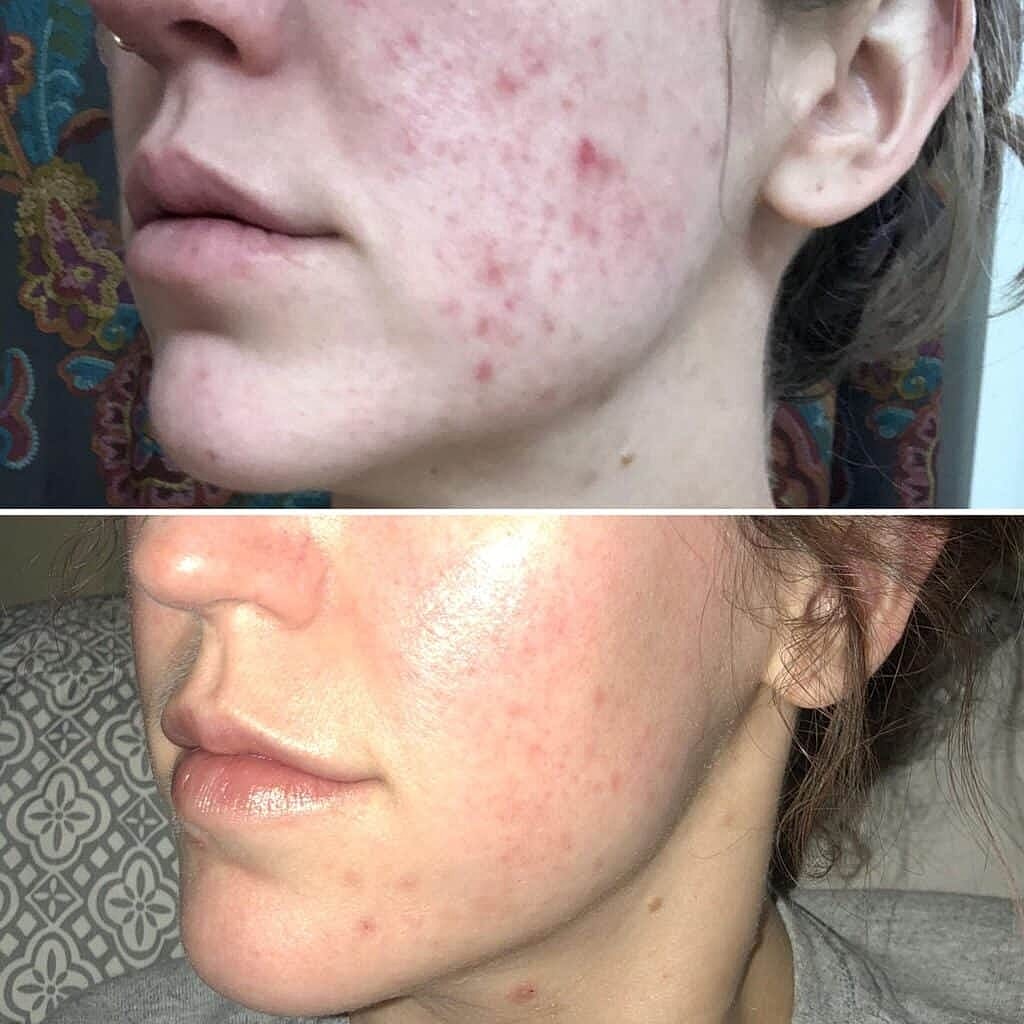 Before & After Image of Microchanneling Columbia MD