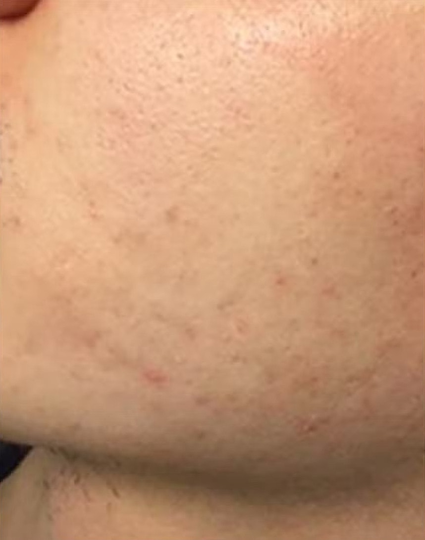 PRX B&A 6