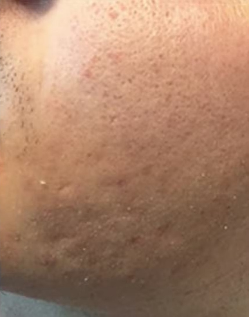 PRX B&A 6